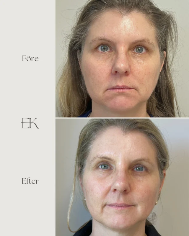 HArmonyCA ✨ Fint och naturligt resultat - Mer spänst & en friskare hud! 😍 Få ett direkt lyft samt ett gradvist långverkande lyft genom att kroppens egna kollagenproduktion ökar! 🙌🏼
